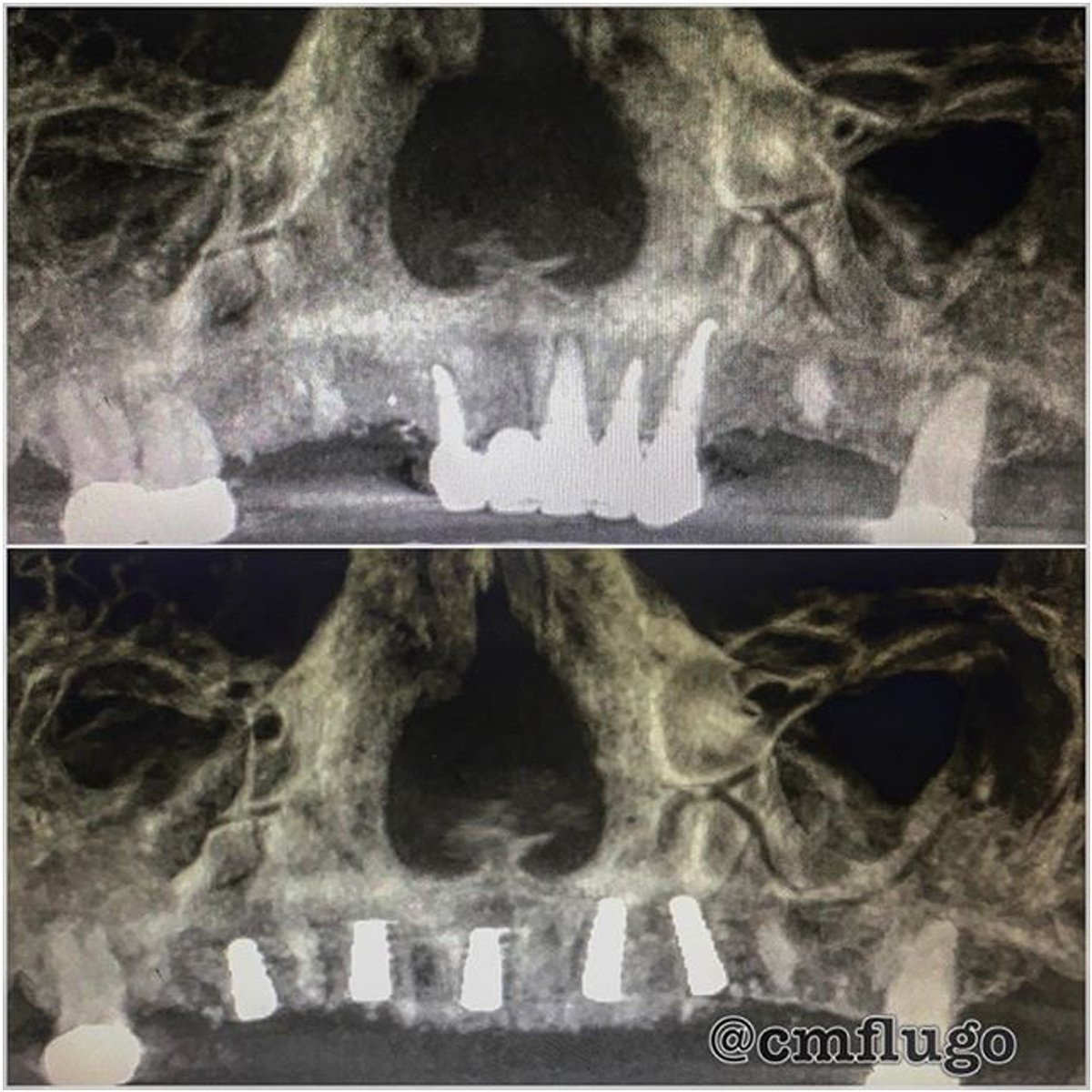 In some cases, we need to use a a All on 5 implants. 😉 ➡ allon4cancun.com
#implants #allon5 #cds