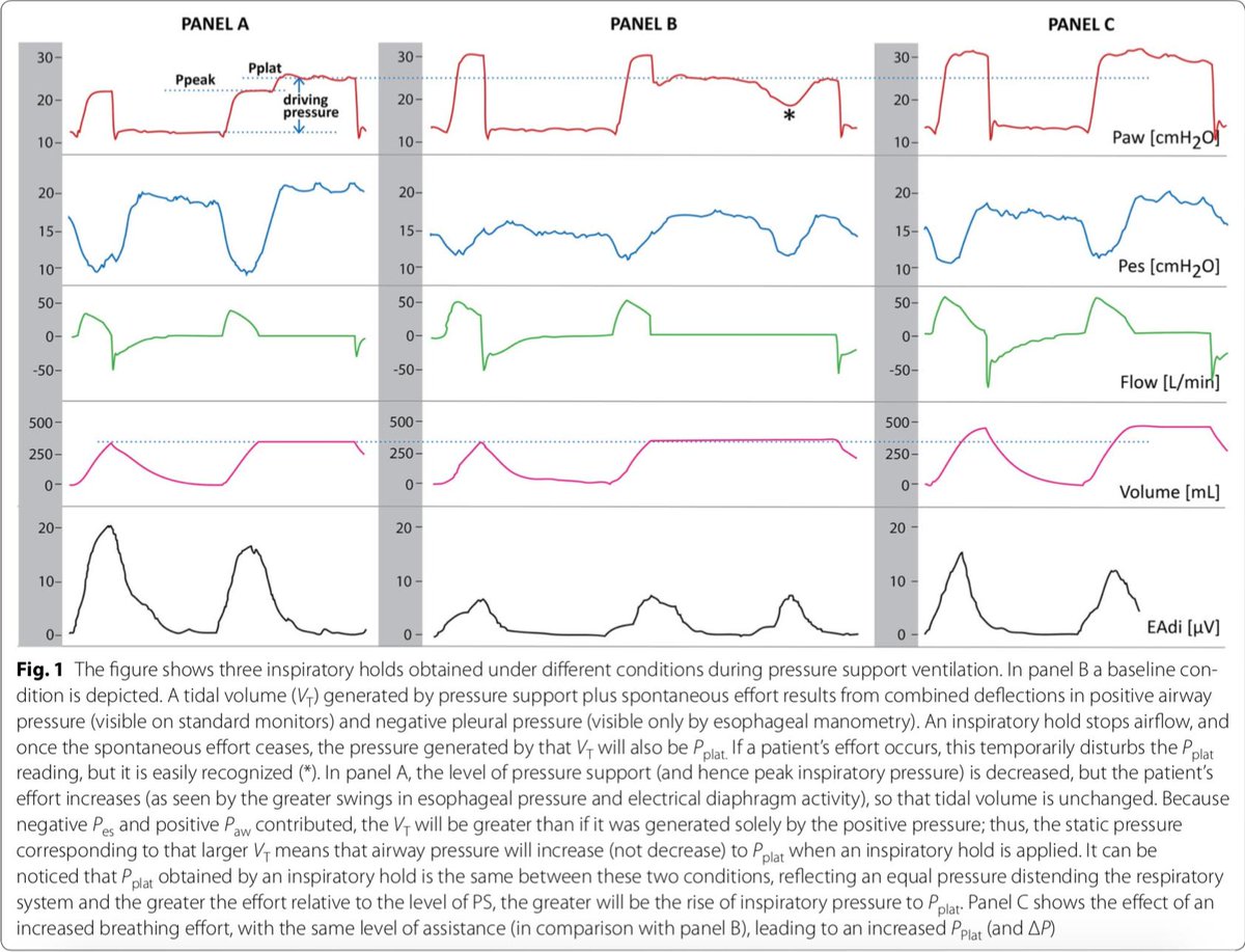 Can we estimate plateau pressure and driving pressure during spontaneous effort?
Free link: goo.gl/QyKbc5
<a href="/GicoBellani/">Giacomo Bellani</a> <a href="/HlmsJ/">HlmsJul</a> <a href="/Dr_Cit/">Giuseppe Citerio</a> <a href="/ClinMedJournals/">Springer Medicine</a> <a href="/ESICM/">ESICM</a>