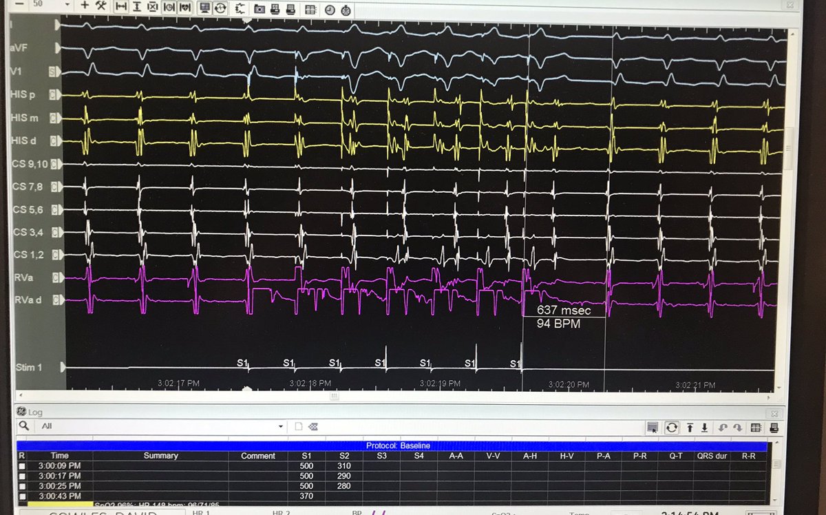 Treacherous slow pathway anatomy mapped and safely ablated w/ much improved handling & resolution of the Tacticath SE. Have other #EPeeps encountered such horizontal anatomy? Bonus points to fellows who can describe EP maneuvers shown... #ablationissalvation