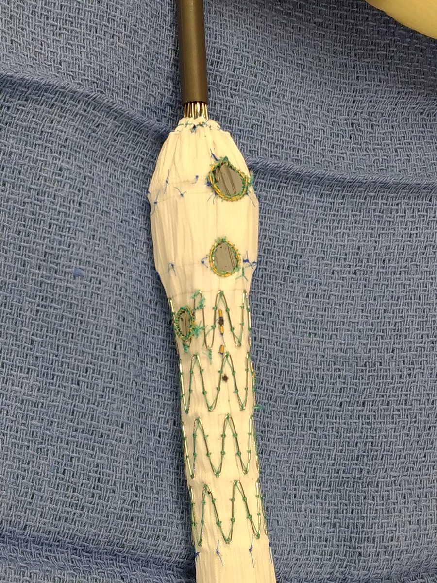 AorticCenter's tweet photo. Blank ZFEN Platform to the rescue! 59 year old with abdominal pain and contained leak of 4.9 cm Juxtarenal AAA. Hemodynamically stable so I had time to modify while the patient was being transported by ground.🌧️ https://t.co/V1rl1kJcYT
