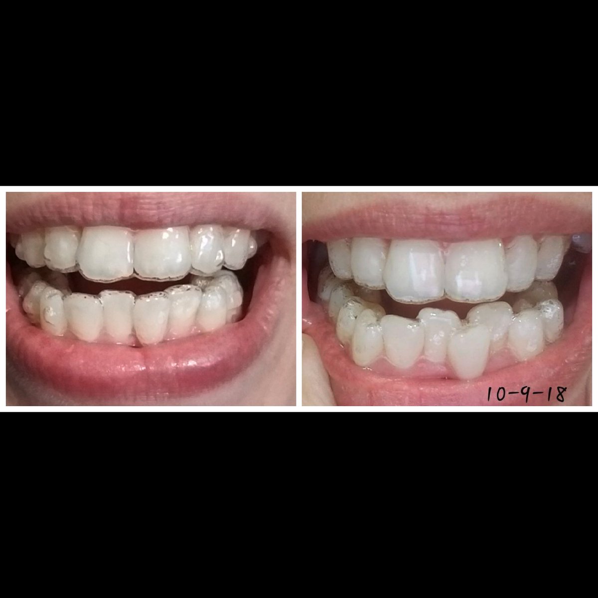 shands87's tweet photo. #Invisalign #newtray19 #startedoct2018 https://t.co/DAZfD9yqYC