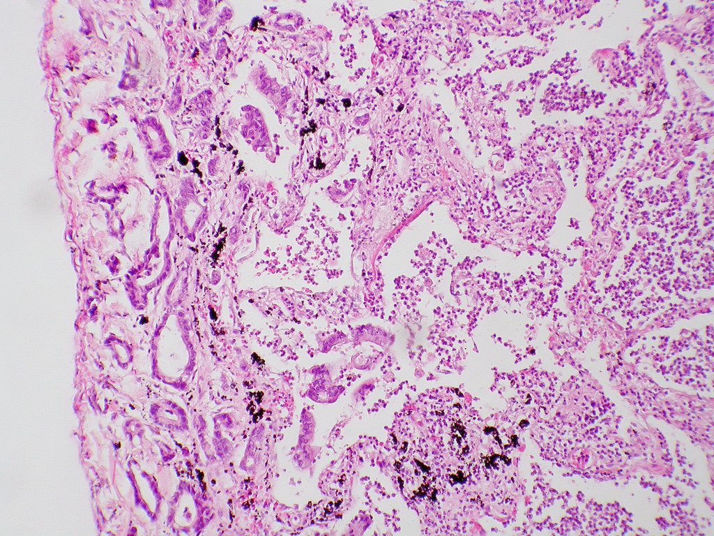 summit_diabetes's tweet photo. Reprogrammed human #pancreaticcells can be used in treating #diabetes in mice.

Get more details at https://t.co/lIUbhqECjY 

#summit_diabetes #diabetes_gatherings #obesity_meetings #heart_congress #london @summit_diabetes @DiabetesUK @Diabetescouk @obesity_tweet @ObesitySociety https://t.co/cQ2ek71kRU