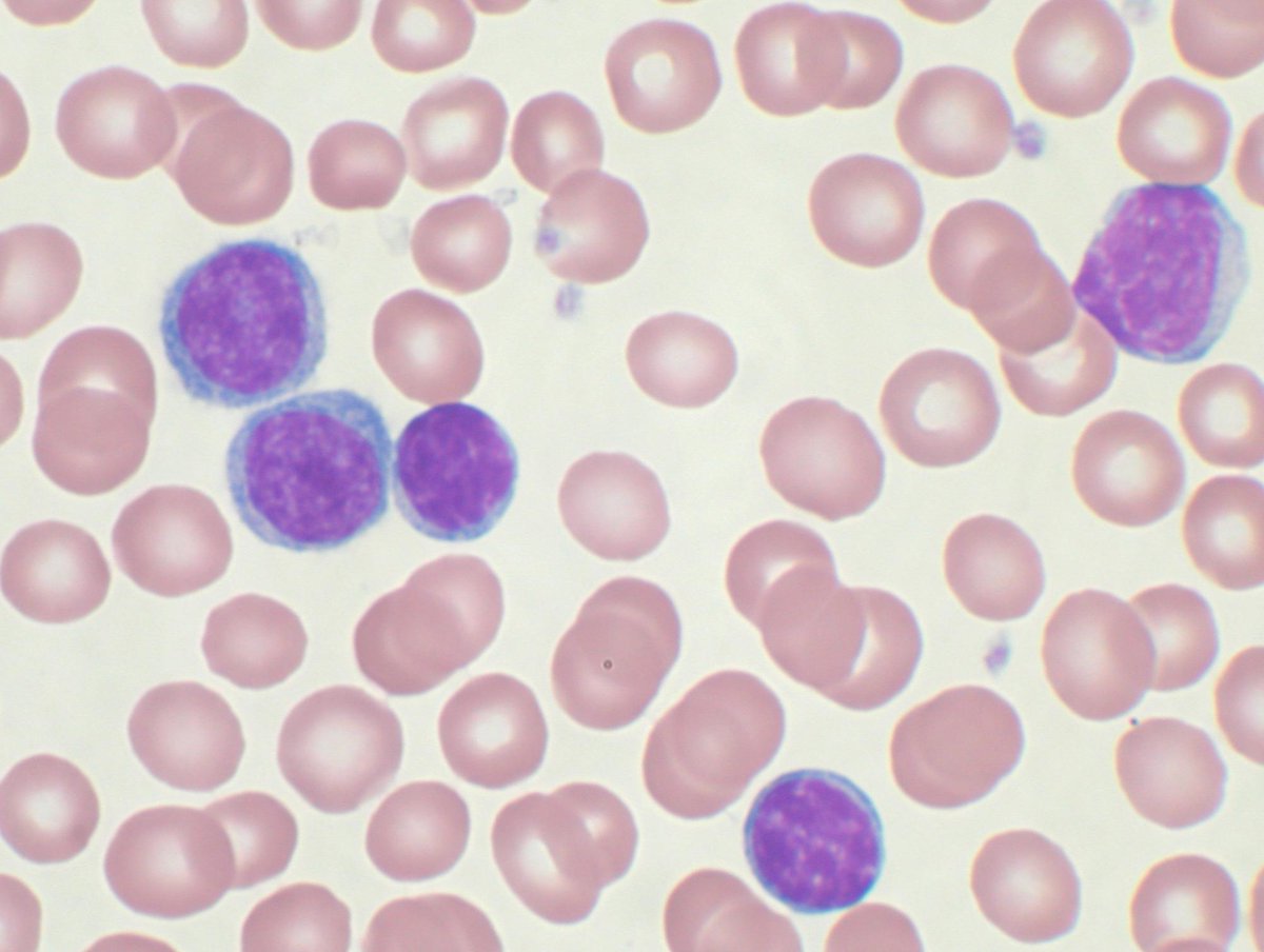 summit_diabetes's tweet photo. Children with #obesity can have a higher risk of developing #Leukemia.

Get more details at https://t.co/lIUbhqECjY

#summit_diabetes #diabetes_congress #obesity_conference #heart_meetings #london @summit_diabetes @DiabetesUK @obesity_tweet @WorldObesity @ObesitySociety @AAHFN https://t.co/wVRjztAyb8