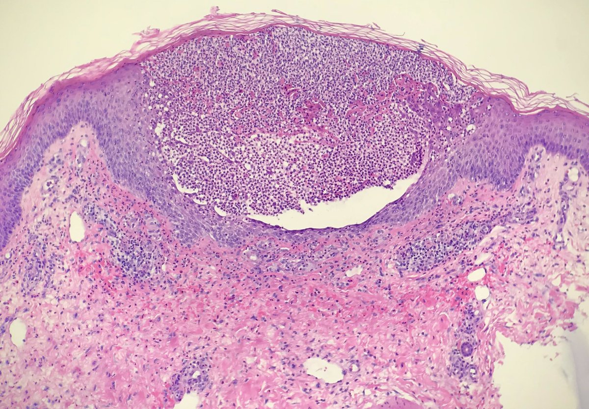 pustular psoriasis pathology