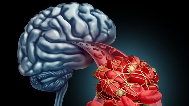 Cornell BME (@cornellbme) on Twitter photo "Unclogging blood flow to the brain could open the floodgates for Alzheimerās treatment." Rock star research coming out of <a href="/Cornell/">Cornell University</a> <a href="/CornellBME/">Cornell BME</a> <a href="/CornellEng/">Cornell Engineering</a> <a href="/SN_Lab/">SchafferNishimuraLab</a>. with <a href="/nwtls/">New Atlas</a> newatlas.com/unclog-blood-f⦠"Unclogging blood flow to the brain could open the floodgates for Alzheimerās treatment." Rock star research coming out of <a href="/Cornell/">Cornell University</a> <a href="/CornellBME/">Cornell BME</a> <a href="/CornellEng/">Cornell Engineering</a> <a href="/SN_Lab/">SchafferNishimuraLab</a>. with <a href="/nwtls/">New Atlas</a> newatlas.com/unclog-blood-fā¦