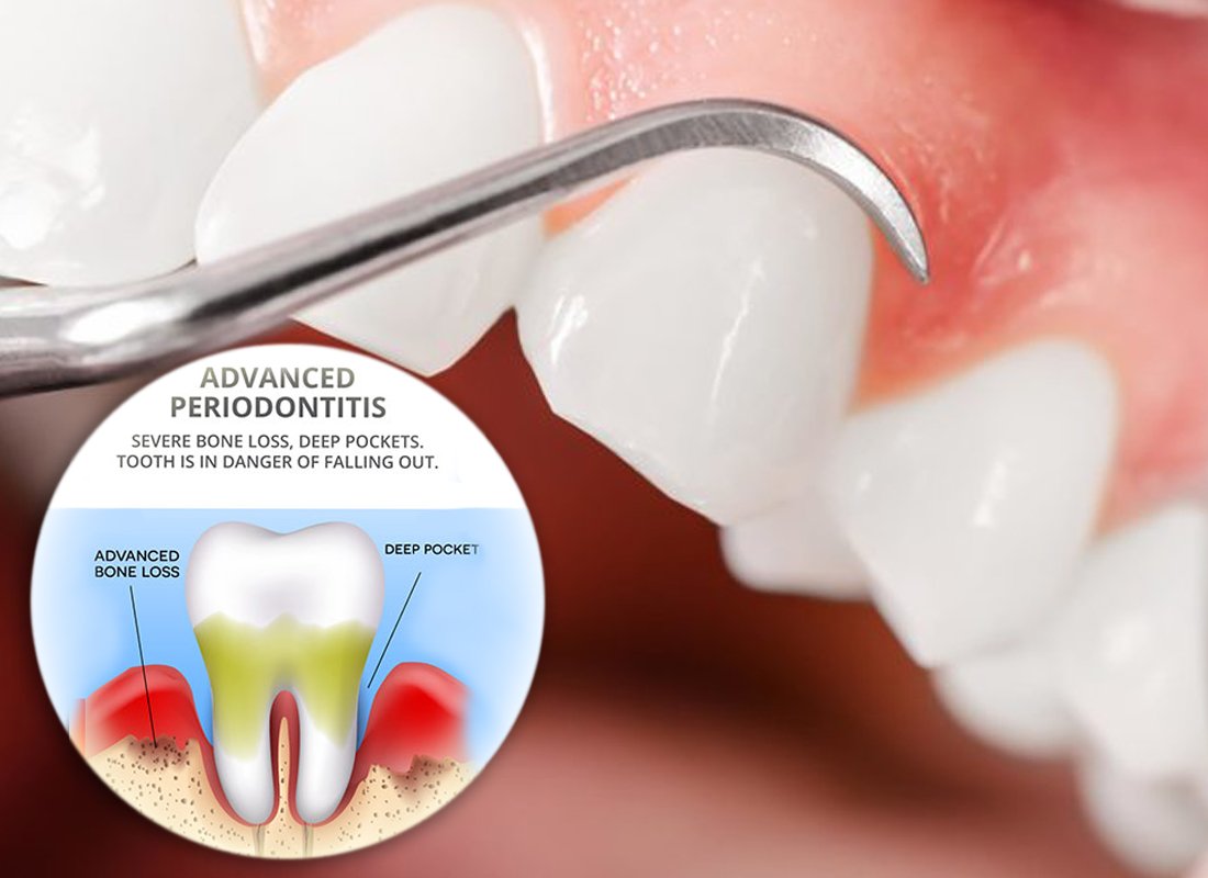 Gum Disease Is Rare, So I Don’t Need To Worry About It....

Most people know that tooth decay (cavities) is very common. Just about everyone has had at least one cavity. But gum disease is rare, right? So you don’t need to worry.
search.google.com/local/posts?q=…