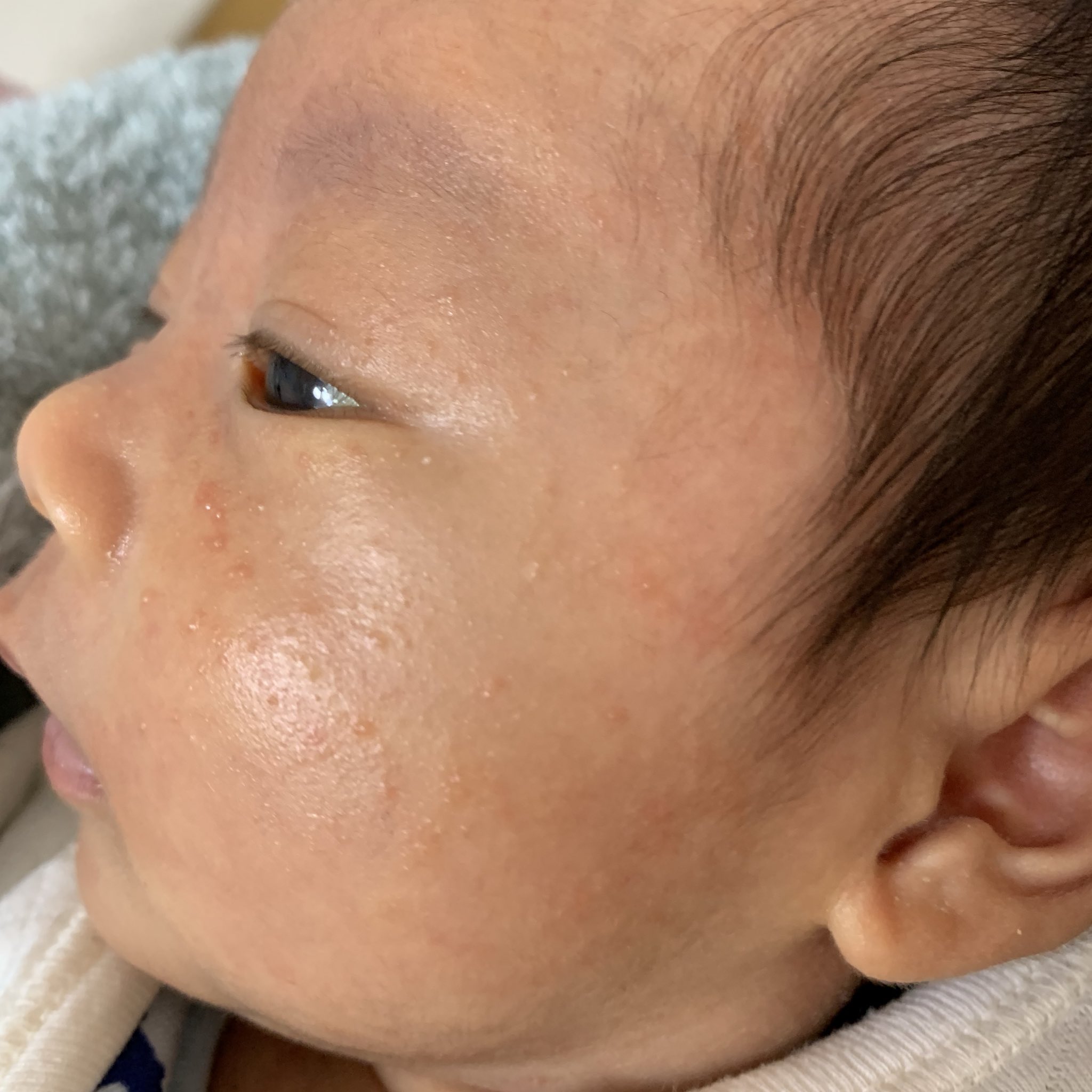 まーこ 8m En Twitter 今日は昨日と比べてだいぶいい 赤みがひいた 乳児湿疹 T Co Esyur0hej7 Twitter