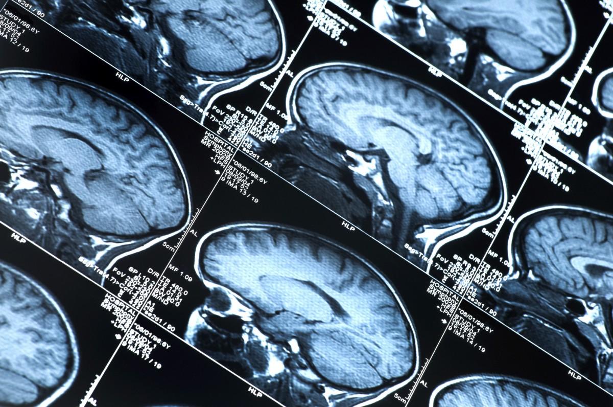 ParkinsonsUK's tweet photo. In a couple of weeks, the full results of the pioneering #GDNF clinical trial will be published. The ground-breaking trial aimed to show whether GDNF can slow, stop or reverse the course of #Parkinsons. We’ll share the results as soon as they're announced https://t.co/40itUBK1rm https://t.co/I430XO6txj