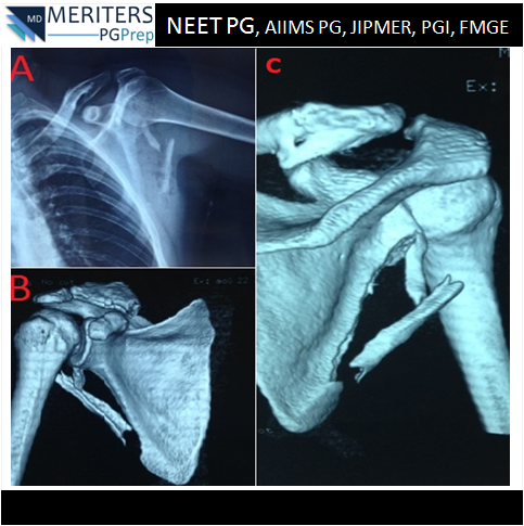 pg_prep's tweet photo. What is your diagnosis?
1. Glenohumeral dislocation
2. Fracture of the humerus and scapula
3. Fracture of the acronium
4. Fracutre of the scapula

#NEET_PG #AIIMS #JIPMER #PGI #DNB #Medicine #PG_Medical_Entrance #NEETPG #MedicalEntrance #Doctor #Medical #PGPrep #ImageMCQs #ENT https://t.co/QVUwF5KjNa