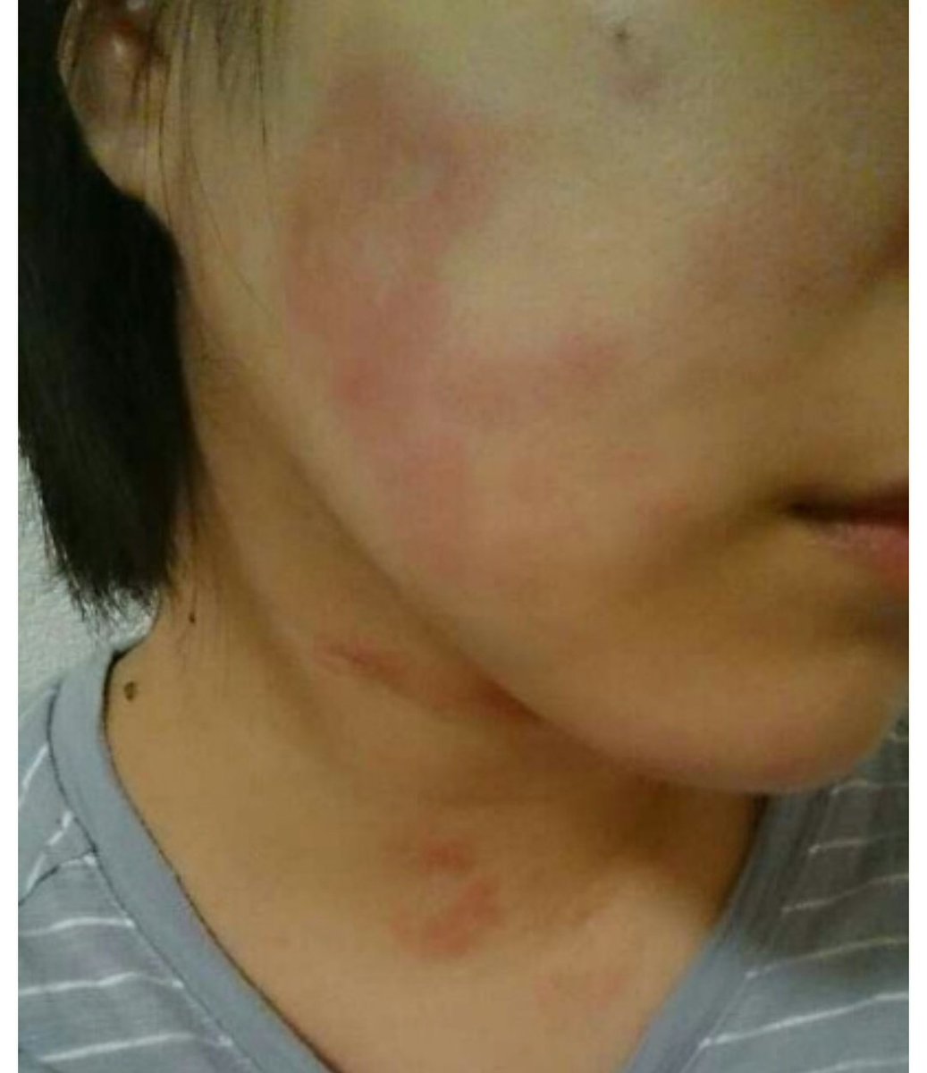 ペーターt ありがとうございます 湿疹の感じが似てる所と小さなブツブツとあります 検査の結果がどう出るかです