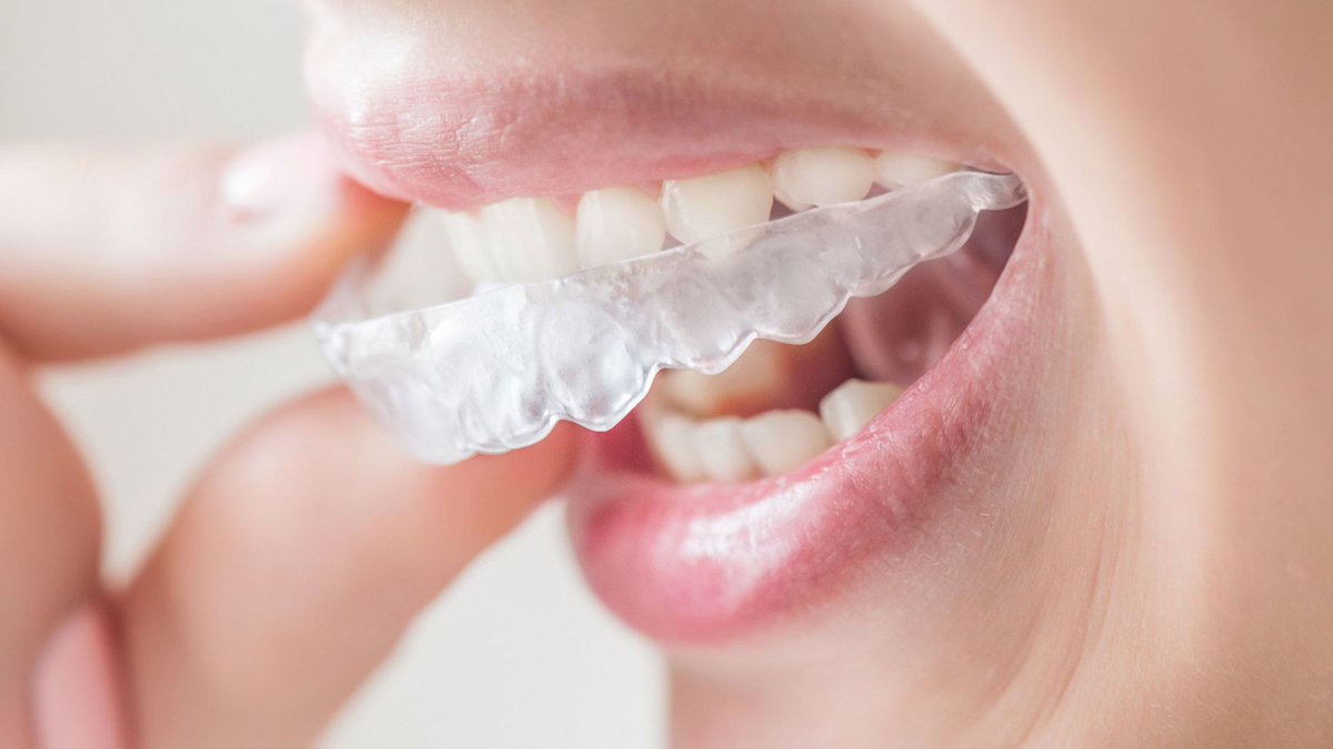 clear_forward's tweet photo. With our Clinical Expertise &amp; the Arcad VSI software we can create a clear aligner treatment plan design as recommended by the orthodontist. 

Get in touch with us for more info: 📞 +44 (0)20 8123 3100 https://t.co/tz8W9sf6vw