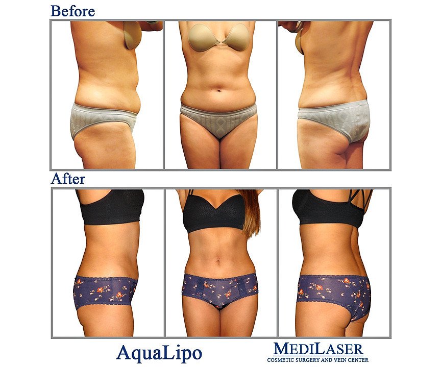 liposuction risks liposuction risks