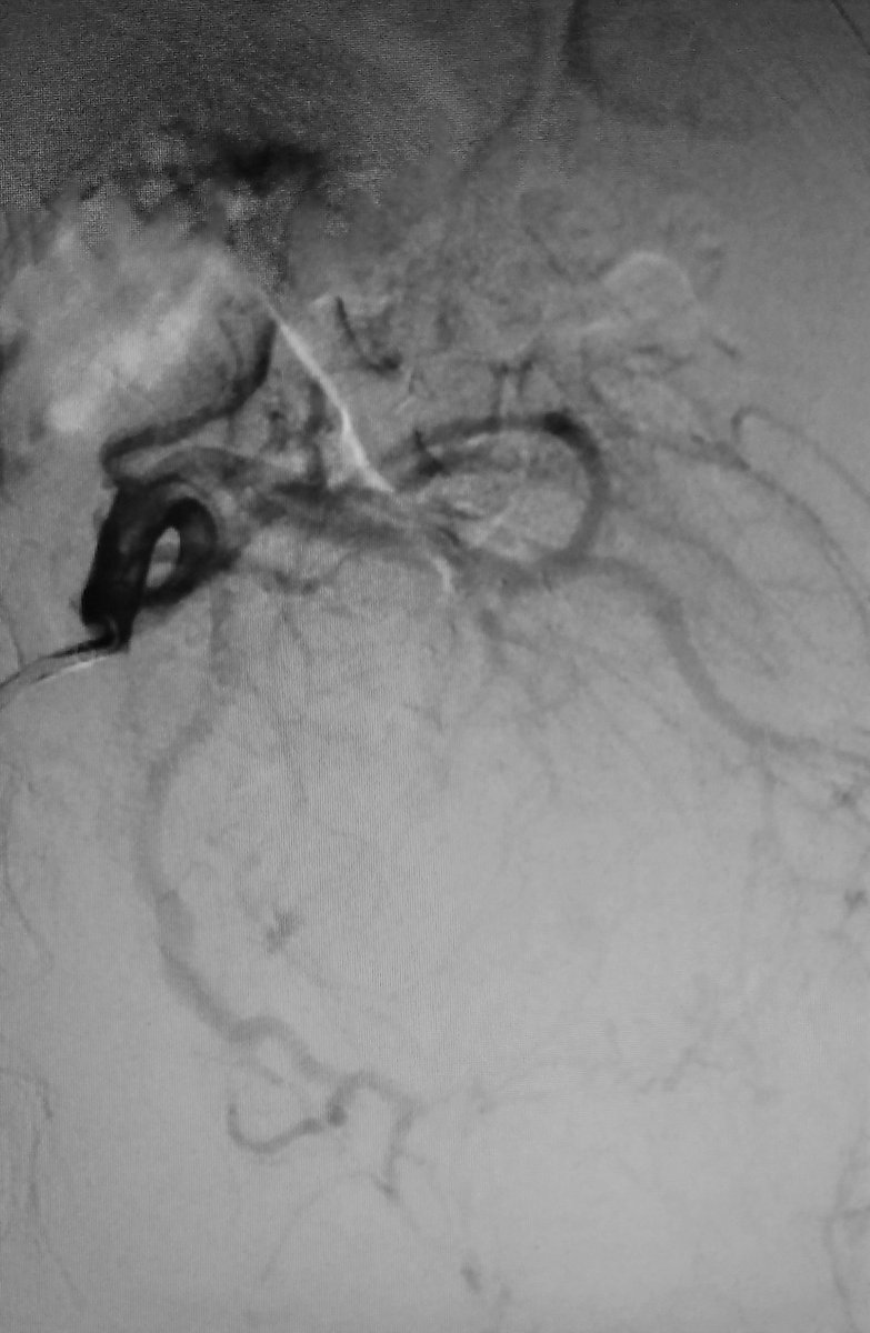 BSIR_News's tweet photo. So yesterday's huge 20cm AML successfully embolised with particles. Not coiled today, to preserve future access if needed #WithoutAScalpel #pinholesurgery #ImageGuidedSurgery Home tomorrow after pain control https://t.co/yOfxg4WQWI