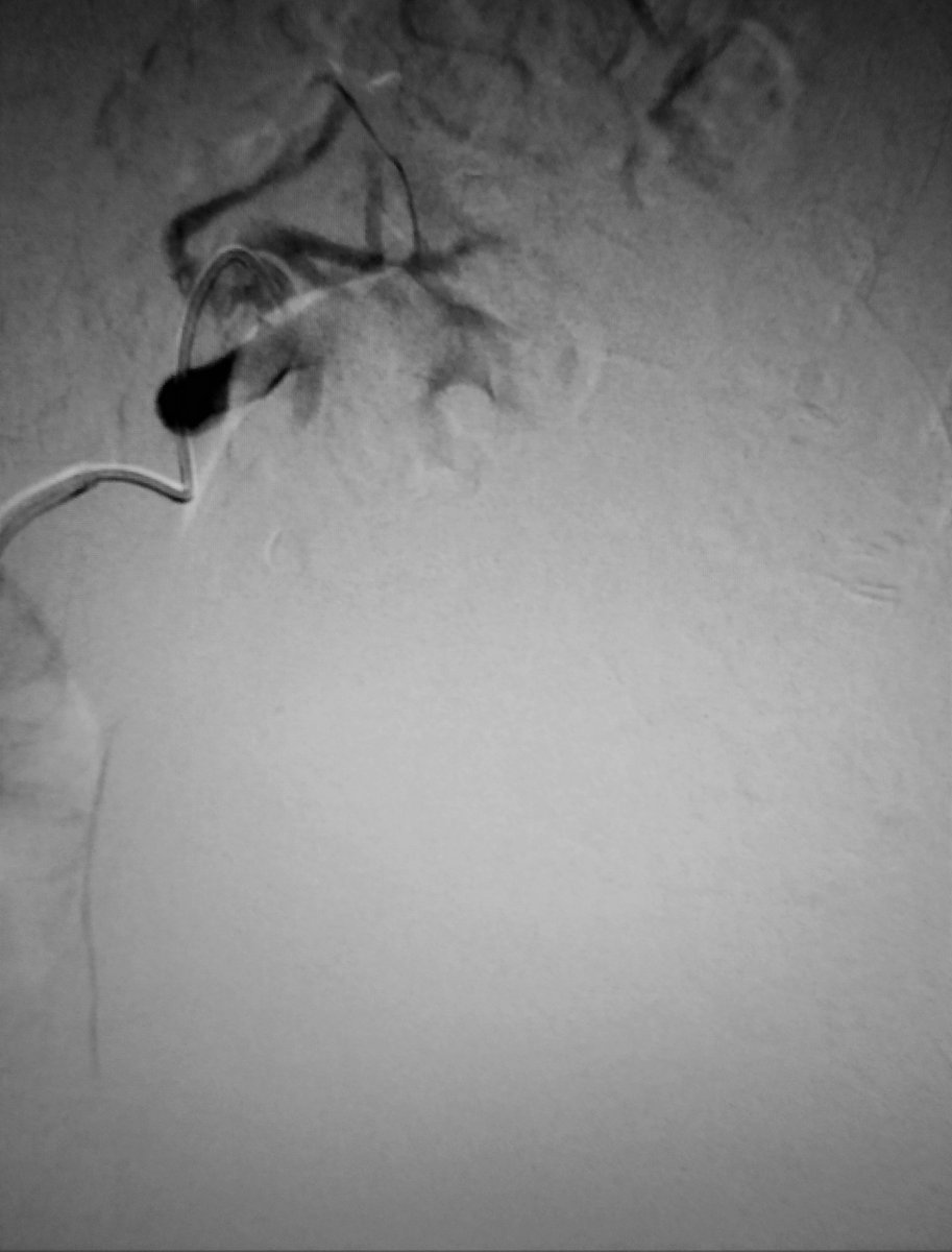 BSIR_News's tweet photo. So yesterday's huge 20cm AML successfully embolised with particles. Not coiled today, to preserve future access if needed #WithoutAScalpel #pinholesurgery #ImageGuidedSurgery Home tomorrow after pain control https://t.co/yOfxg4WQWI