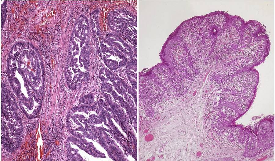 sortizreina's tweet photo. Perianal Paget disease secondary to pagetoid growth of a anal canal adenocarcinoma.
#dermpath #pathology https://t.co/vjAakqZ1hA