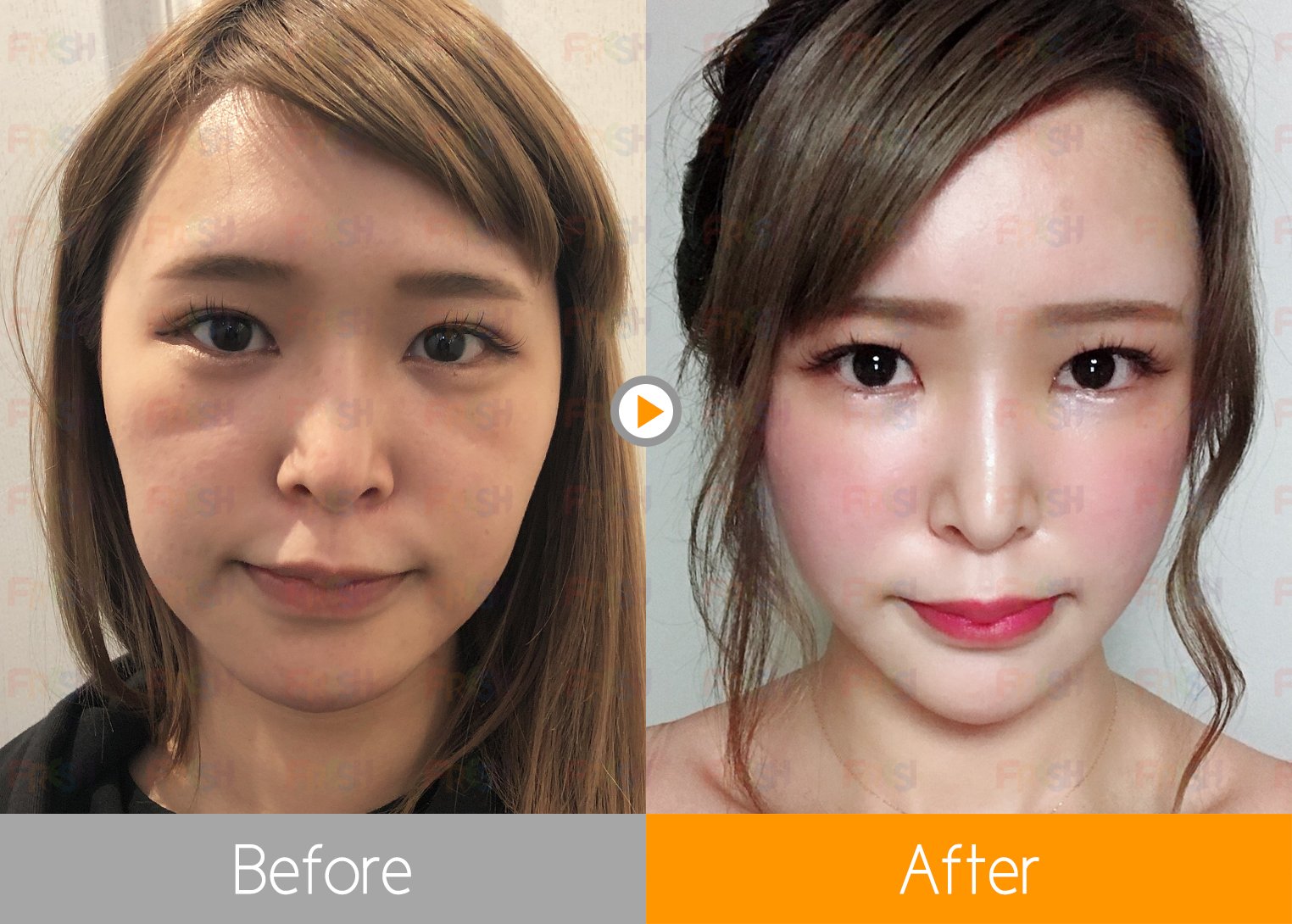 Twitter 上的 フレッシュ整形外科 顔の脂肪移植で気になっていたゴルゴ線も解決 脂肪移植で額からあご先にかけて滑らかな輪郭に フレッシュ整形 ホンドクター 美容 整形 韓国整形 脂肪移植 脂肪吸引 フィラー モデル T Co