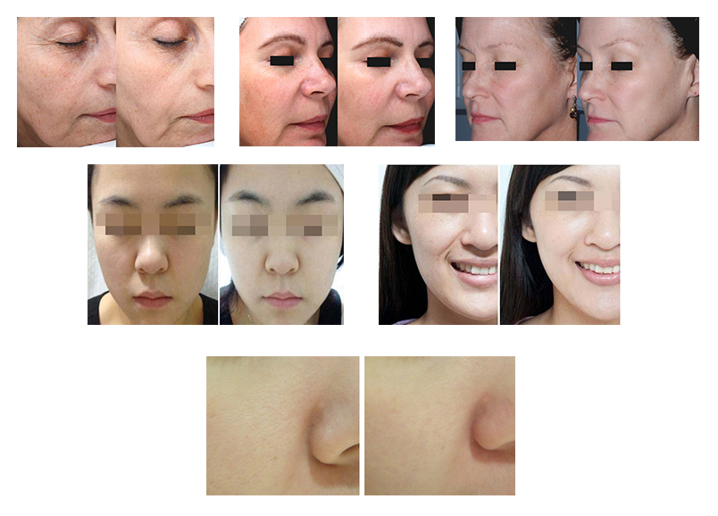 Natasha_gomecy's tweet photo. Professional Gold Micro-needle RF Fractional Device
For skin tightening, face lift, skin rejuvenation
Acne scar removal, removal stretch marks

#microneedle #rffranctional #skincare #skinsmooth #stretchmarkremoval #acnescarremoval #skinrejuvenation #wrinkleremvoal #poretightening https://t.co/bRGZKky1xu
