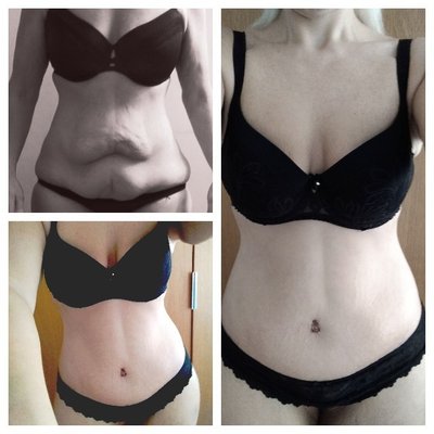 ukaesthetic's tweet photo. Amazing results for my lovely patient following a lower body lift with bodyjet liposuction to the thighs. #realselfreview #lowerbodylift #bodyjetliposuction #patientfeedback #cosmeticsurgeon #plasticsurgeon #garyross #ukaesthetic https://t.co/HjnssuqOib