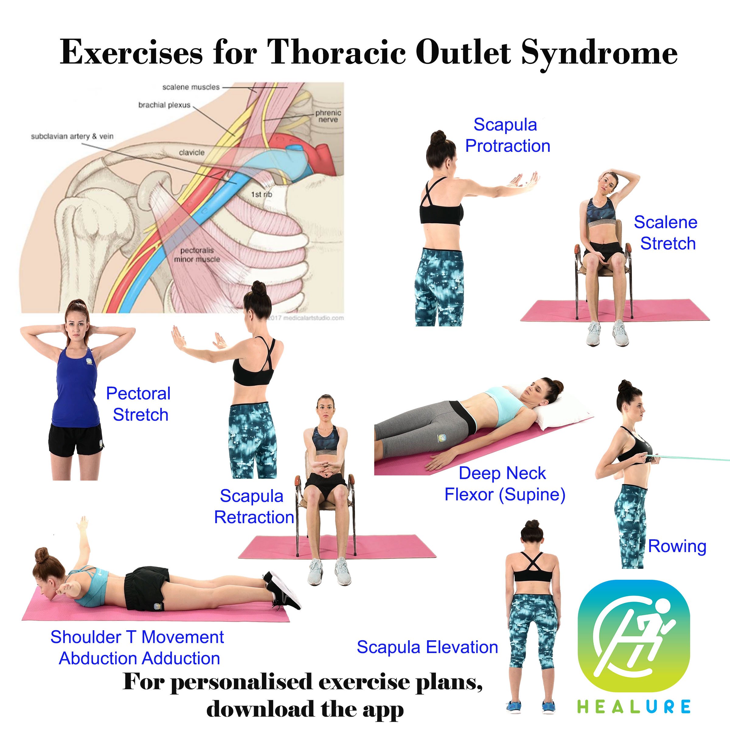 Figure 4 from Thoracic outlet syndrome.
