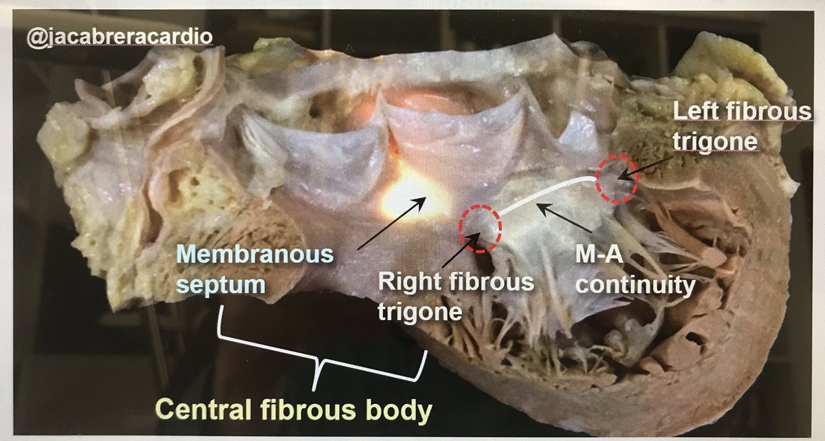 Sharing this dissection of our group to clarify central illustration of Vijayaraman’s excellent review of His bundle pacing in JACC doi.org/10.1016/j.jacc… <a href="/adribaran/">Adrian Baranchuk MD FACC FRCPC FCCS FSIAC</a> <a href="/ALFIEEP1/">ALBERTO ALFIE</a> <a href="/j_alvarezgarcia/">Jesús Álvarez-García</a>  <a href="/iamritu/">Ritu Thamman MD</a> <a href="/miguel_a_arias_/">Miguel Angel Arias</a> <a href="/PrashSanders/">Prash Sanders</a> <a href="/drraviele/">Raviele Antonio</a> <a href="/blogarritmias/">Blog Arritmias ARC</a> <a href="/JACCJournals/">JACC Journals</a>