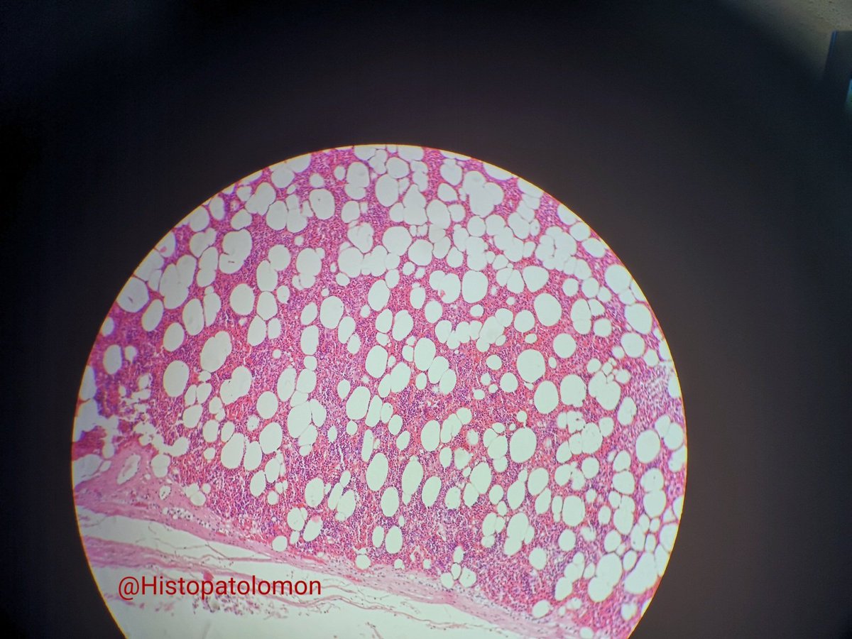 Histopatolomon's tweet photo. This is the micro. #myelolipoma #adrenal #adrenalgland #endocrinepath #endopath #BSTpath #grossmicropath #macromicropath #grossmicrocorrelation https://t.co/b6G5bvywUO