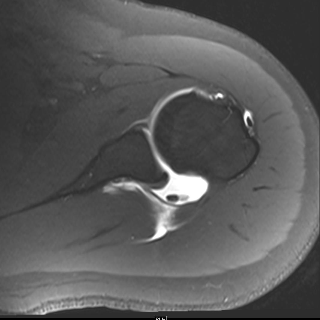 NshRadiology's tweet photo. Our first #MR #arthrogram for the left shoulder following #Gadolinium injection using #Ultrasound Guidance rather than #Fluoroscopy guidance. Loose bodies are noted from an ALPSA lesion. https://t.co/jievfBeXXC