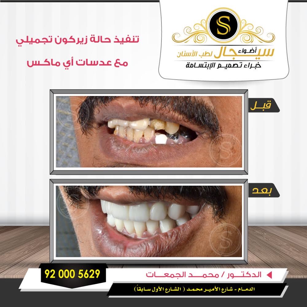 كل ابتسامة تحكي قصه 
ابدأ قصتك بزياره واحده لعيادات سيجال 🌹
#صناع_الإبتسامه #سيجال_صناع_الإبتسامة #سيجال #الدمام
#صحتك_تهمنا #سيجال 
#Veneer
#luminer #Zircon
#hollywood_smile
#Hollywood_smile
#Attractive_smile
#Teeth #Smile #Beautiful_smile