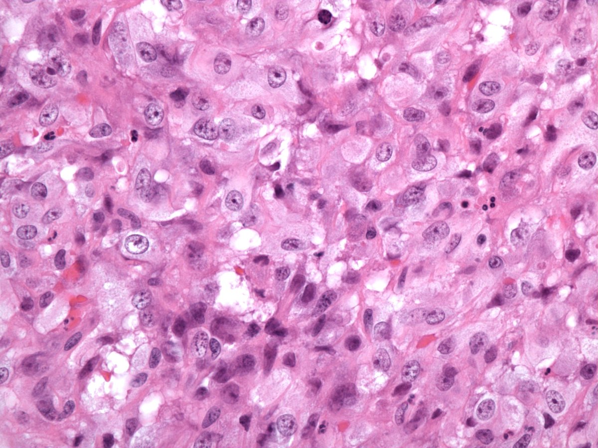 Cutaneous epithelioid angiomatous nodule. Benign vascular tumor composed of circumscribed sheet-like proliferation of epithelioid endothelial cells. First described by Brenn and Fletcher PubMed PMID: 14726818. #dermpath