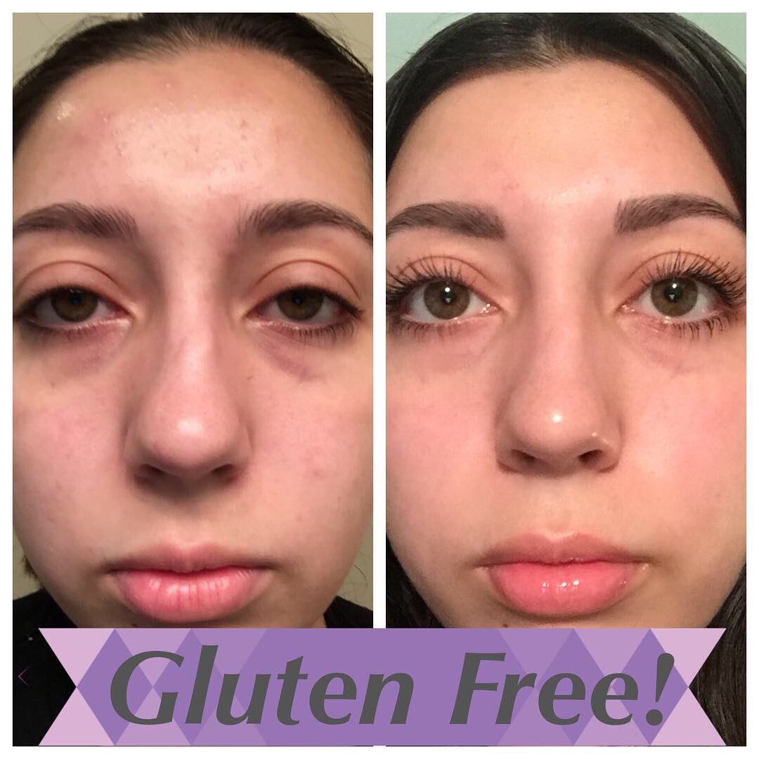 Celiac Eyes