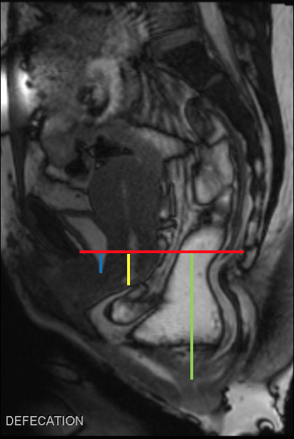 xsectional's tweet photo. Case 3: All three compartments of the pelvis are involved as indicated by cystocele (blue), uterine prolapse (yellow) and rectal prolapse (green). There is no anismus in this case since fecal material can be seen in defecation.#radres #MRI #radeducation #xsectional #defecography https://t.co/YHqYeK1zpu