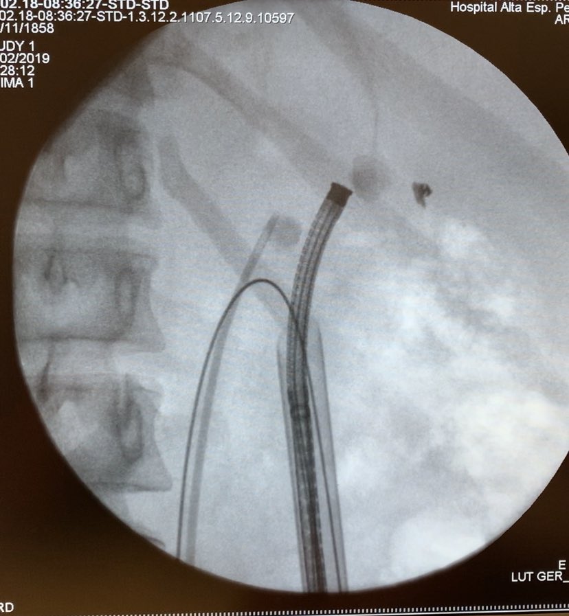 karenmbravo's tweet photo. • Tips and Tricks •
NLPC prono + cistoscopia flexible + litotricia neumática y láser @uronavarrete @PCNL_challenges @UroHRAEPY 
#stepbystep #urology #urohraepy #UroSoMe ☄️💥 https://t.co/fQ4zbyaAdF