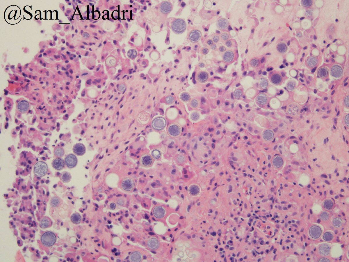 💎Coccidioides immitis Cervical Lymphadenitis 💎@MelanieBoisMD @VandaTorousMD @suraksharaob @aakasharmand @Sara_Jiang @smlungpathguy @BinXu16 @pembeoltulu @NJanakiMD @DrAldehyde @PathologySayah @raghupillappa @edusqo @lara_pijuan @LizaMQuintana @aakasharmand #cytopath #pathology