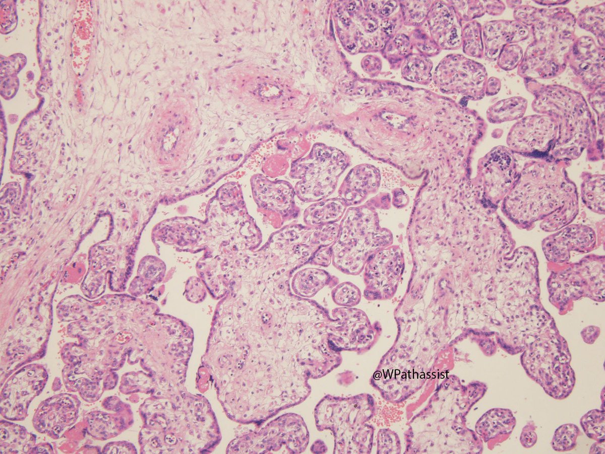 WPathassist's tweet photo. Congenital CMV infection.  CMV inclusions in the placenta! #placentalLove @E_Heidi_Cheek @MayoClinicPath @kabeerkshah @SarahEKerrMD https://t.co/QcEBdpYZEL