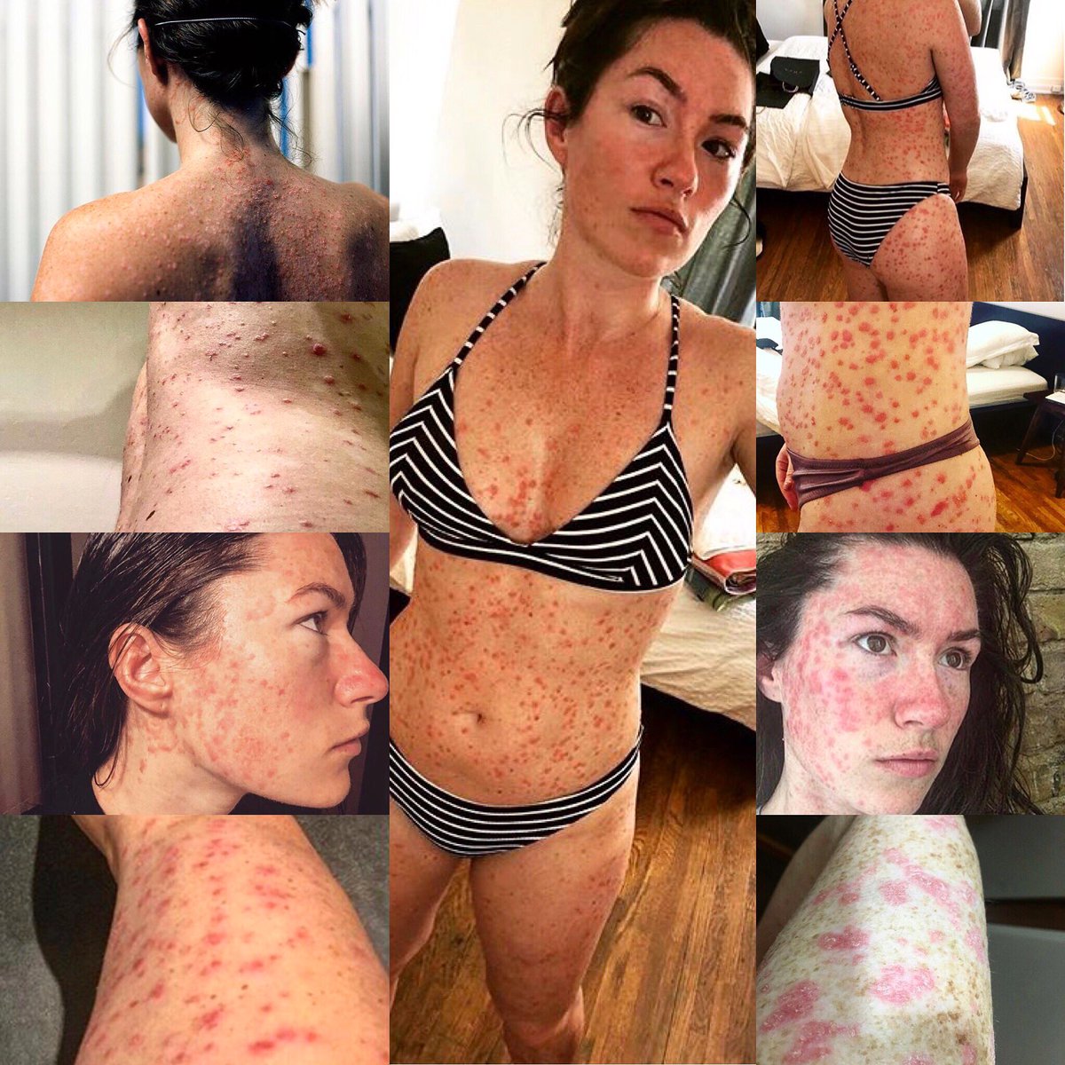 Why is <a href="/instagram/">Instagram</a> blocking body positive movements raising awareness for #psoriasis ? This is not offensive content. Please help to hold instagram accountable and reinstate the #getyourskinout recent post’s #. @Caradelevingne