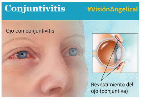 AngelicalVision's tweet photo. La #Conjuntivitis es una irritación o inflamación de la conjuntiva que cubre la parte blanca del globo ocular. Puede ser ocasionada por alergias o una infección bacteriana o viral. 
👩⚕️Dra. Paulina Román Cárdenas
🌐 https://t.co/w7rKlZ7dIk https://t.co/xGBDqU57oc