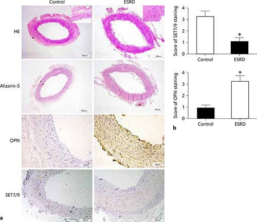 nephron_journal's tweet photo. Amelioration of Uremic Toxin #Indoxyl Sulfate-Induced Osteoblastic #Calcification by #SET Domain Containing #Lysine Methyltransferase 7/9 Protein
๐ฉโโ๏ธ Jing Chen
๐ฐ https://t.co/IcXjUfzIIQ https://t.co/747vXVQHS9
