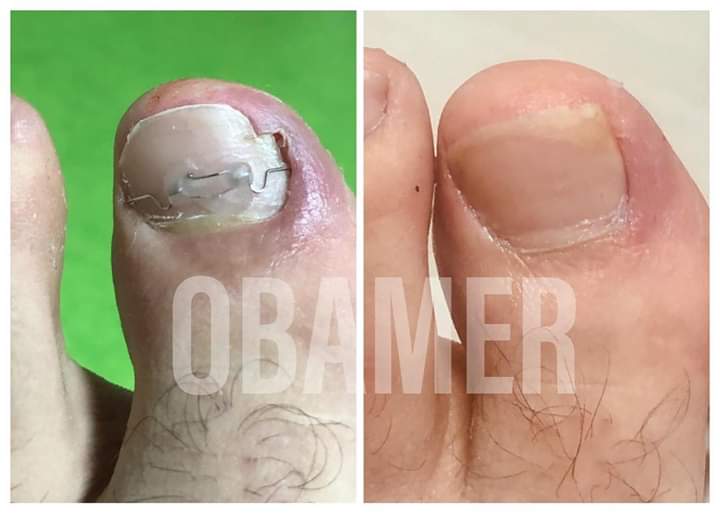 Yanlış kesimden kaynaklanan tırnak batması,erken müdahale ile ilk seansta normale döndü... İşimiz Podoloji,GÜCÜMÜZ Podoloji 🤗 #podoloji #podologie #podologia #podolog #ayaksağlığı #medikalayakbakımı #ayaksağlığımerkezi #ayaksagligiizmir #tırnakbatması