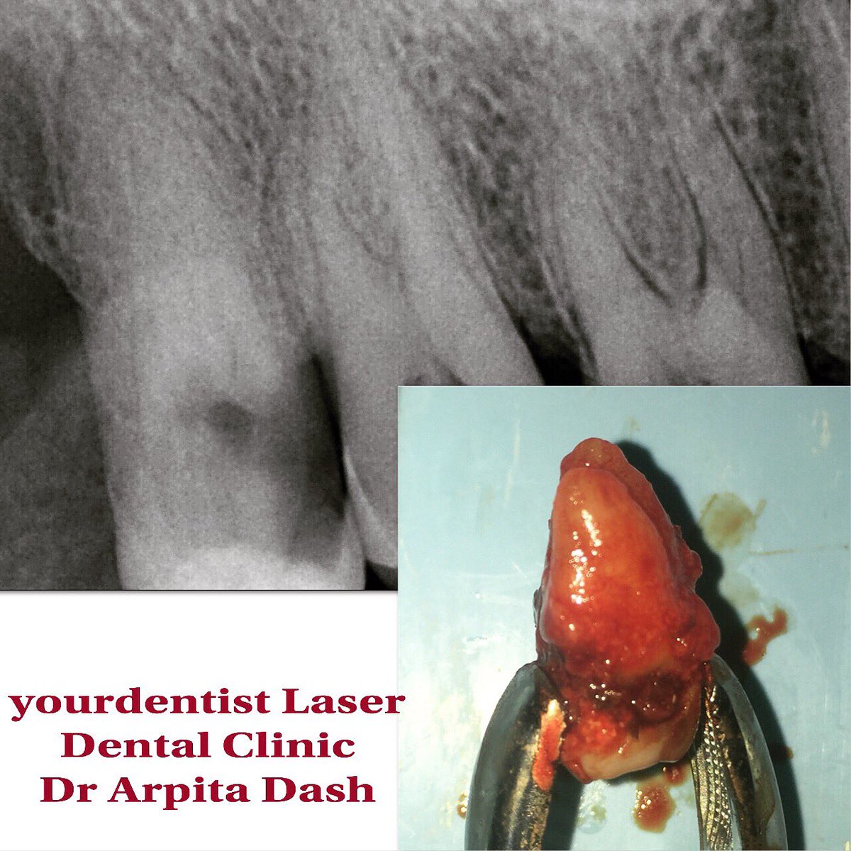 yourdentistpro's tweet image. #Buccaly erupted 18#ineffectual brushing#Dental caries #pulpitis#frictional keratosis on  right inner cheek mucosa#extraction i.r.t 18#yourdentist Laser Dental Clinic #saheed Nagar#Bhubaneswar