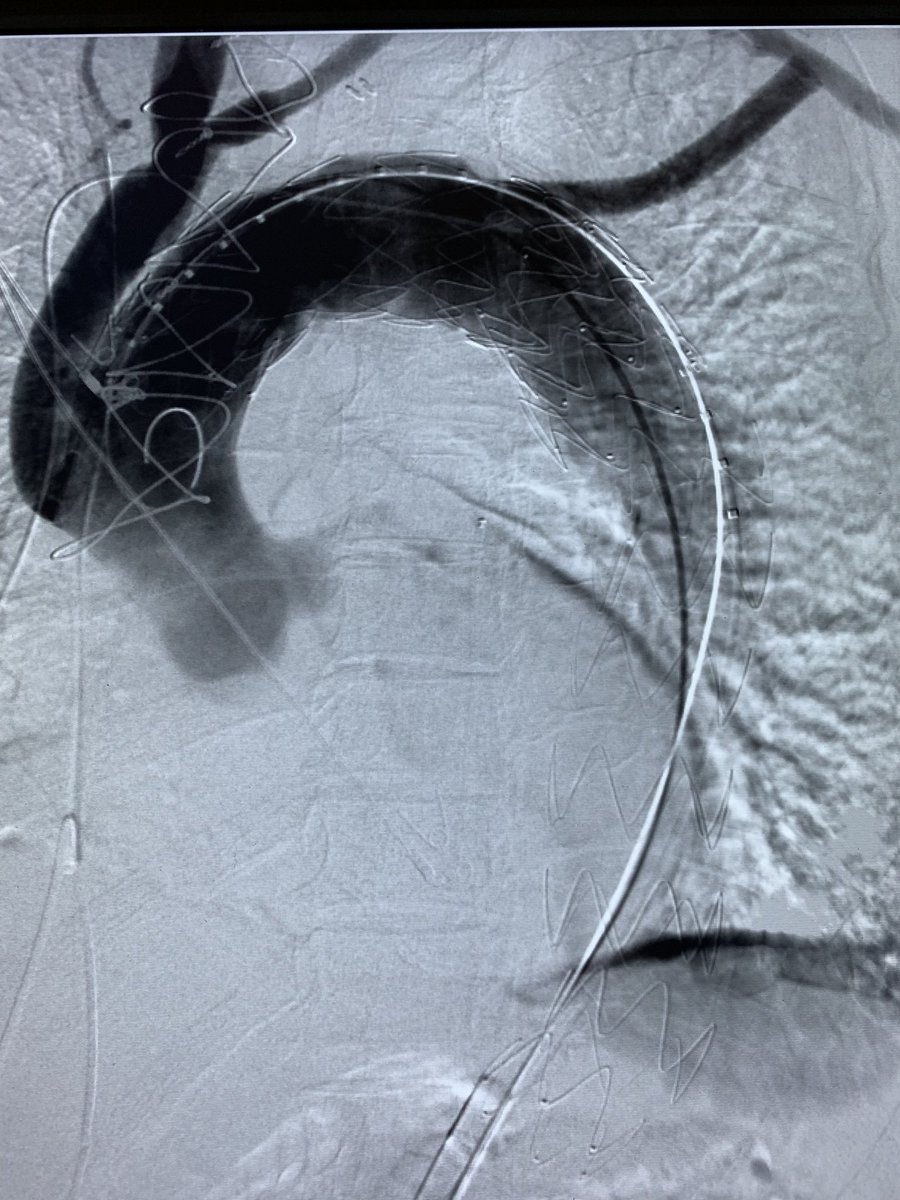 Arch debranching followed by TEVAR.  Hybrid arch procedures are my favorite ...  #aorticsurgery #archrepair #aneurysm #TEVAR