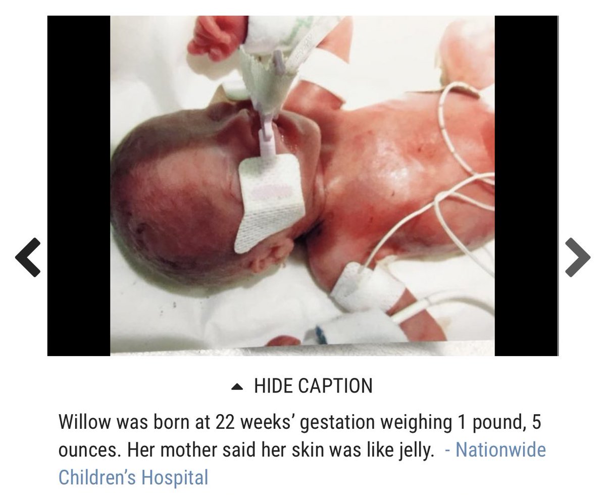 Willow was born at 22 weeks weighing 1 lb 5 oz. https://www.dispatch.com/content/stories/local/2016/11/20/born-at-22-weeks-baby-defies-odds-to-survive-thrive.html