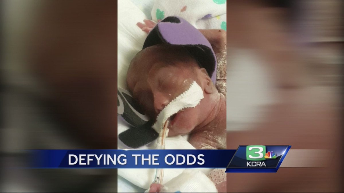 Leni was only 22 weeks and barely over a pound when he was born at home. He was resuscitated by firefighters.  https://gooddaysacramento.cbslocal.com/2018/11/28/nicu-survival-giving-back/