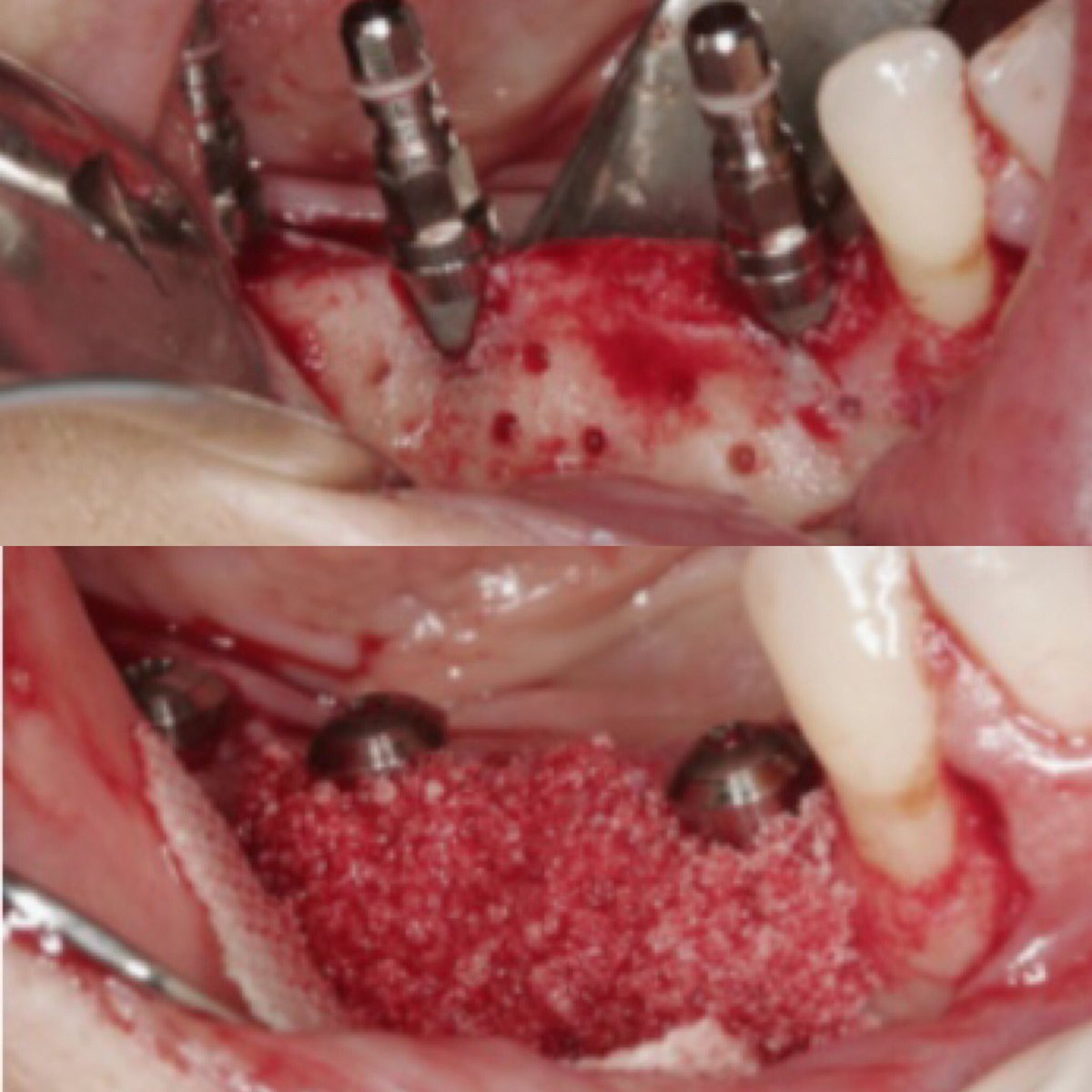 Hesira_Med's tweet image. Ossix membrane #Ossix applied to the defect area visible on the buccal aspect. Friedman et al.
Clin. Oral Impl. Res. 20, 2009/708-714 #Ossification
#CollagenMembrane 
#DentalImplants #OssifyingCollagenScaffold
#BoneGrafting #GuidedTissueRegeneration #DentalMembrane