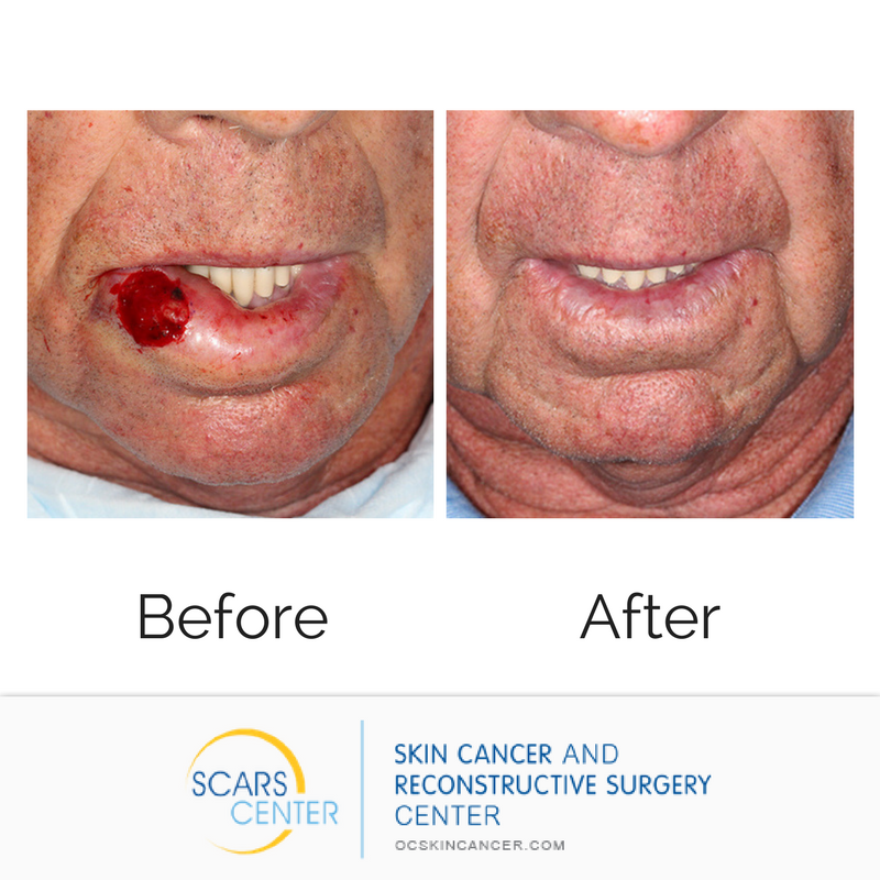 SCARSCenter's tweet image. Do you wear #chapstick with #SPF in it? When your bottom lip reflects and absorbs more light than the top, it's important to wear SPF. Call today to reserve your bottle of #sunscreen: (949) 719-1800