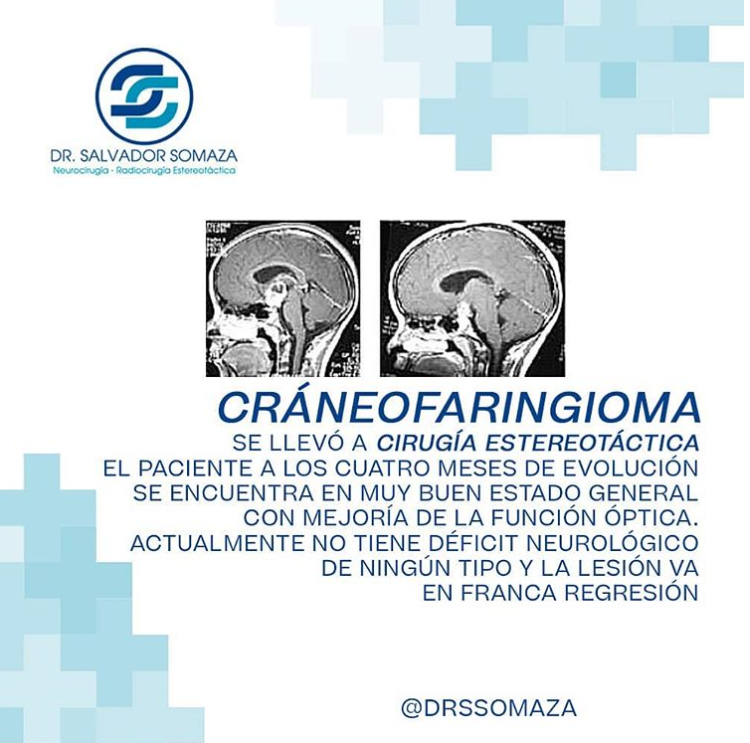 El paciente a los cuatro meses de evolución se encuentra en muy buen estado general con mejoría de la función óptica. Actualmente no tiene déficit neurológico de ningún tipo y la lesión va en franca regresión.
.
#DrSalvadorSomaza