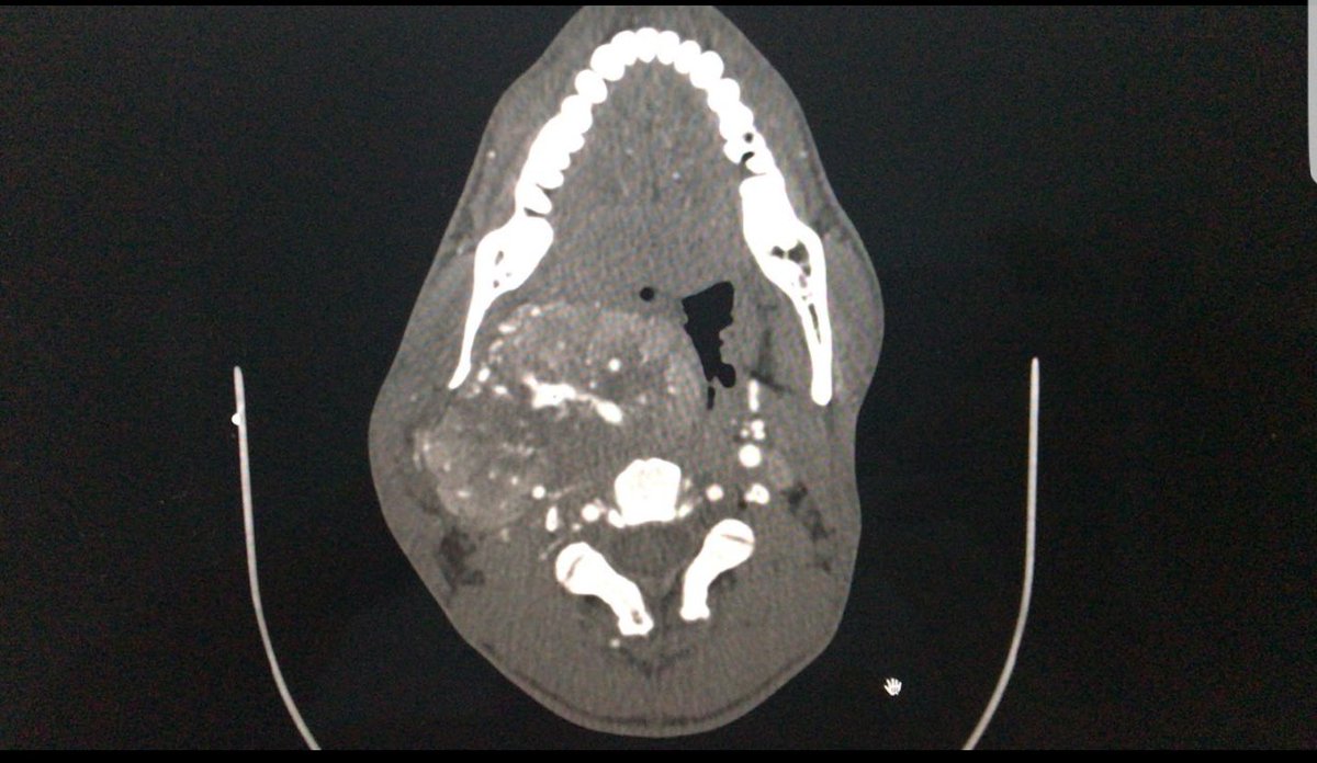 andrebrq's tweet photo. Open #VascularSurgery for a Shamblin III #Carotid body tumor #Paraganglioma #Chemodectoma #Cirurgia Vascular para #Carotida #Tumor de corpo carotídeo #Glomus Carotídeo https://t.co/OJui4WhITG