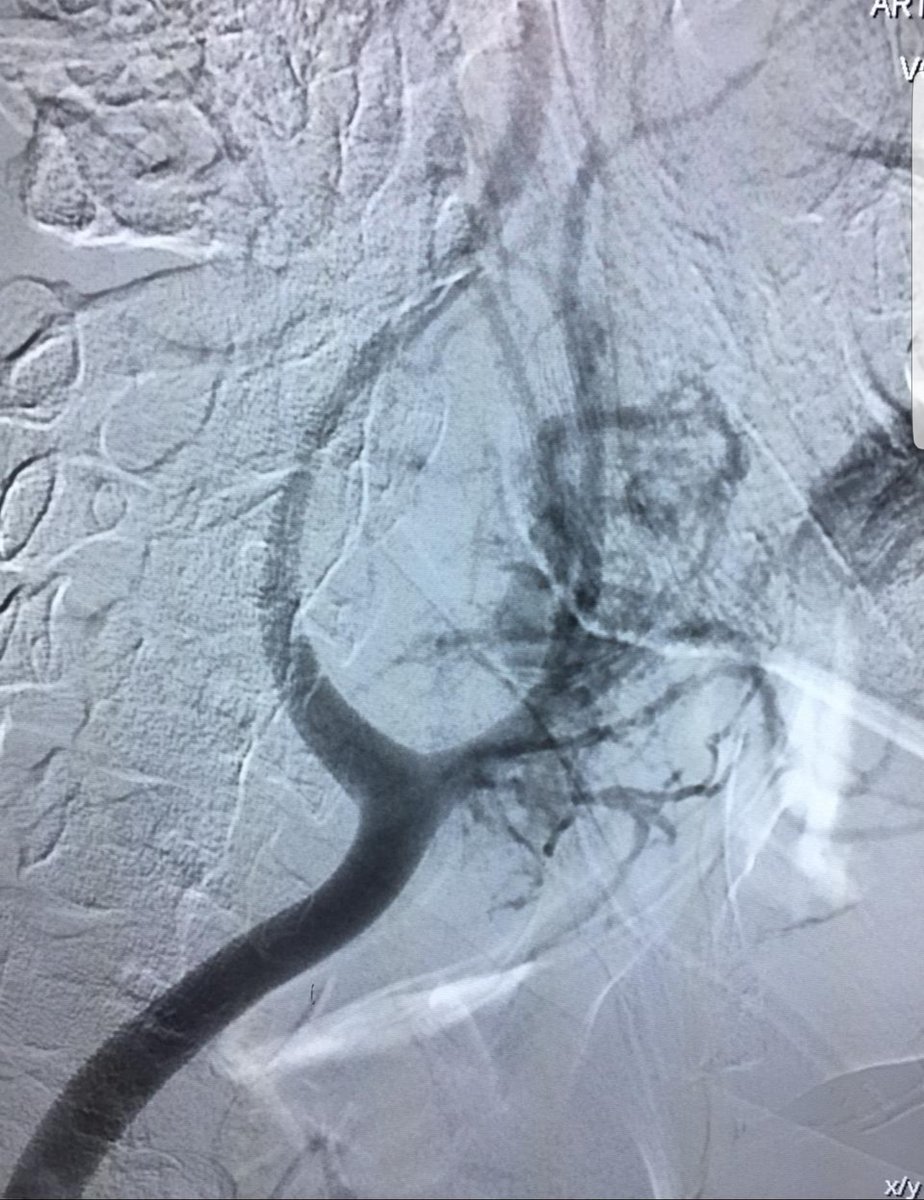 andrebrq's tweet photo. Open #VascularSurgery for a Shamblin III #Carotid body tumor #Paraganglioma #Chemodectoma #Cirurgia Vascular para #Carotida #Tumor de corpo carotídeo #Glomus Carotídeo https://t.co/OJui4WhITG