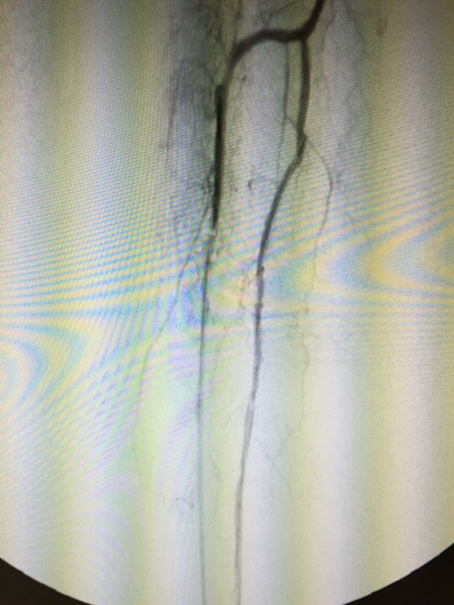 WilliamWuHVC's tweet photo. 82 y/o female with resting pain, non healing ulcer of right heel, Rutherford stage V.
CLI with total occlusion of PT and peroneal artery.  AT pedal approach to intervene posterior tibial artery.
@JamilMalikSTCC @SAIFSanAntonio @KeithNguyenSAIF https://t.co/wcIKbEgmUU
