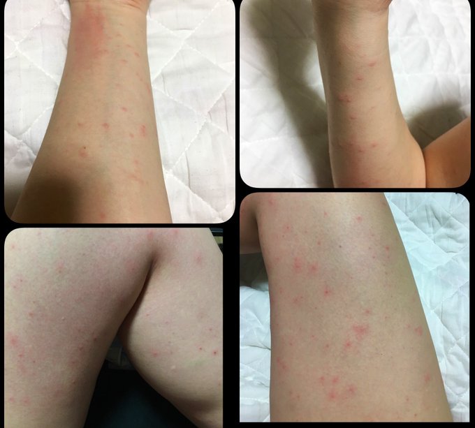 じんま疹 の評価や評判 感想など みんなの反応を1週間ごとにまとめて紹介 ついラン