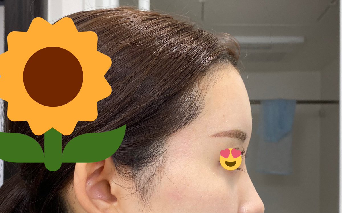 _wanwan_yu's tweet photo. 👶🏻額こめかみ脂肪注入術後7ヶ月と8日👶🏻

7ヶ月経っても脂肪はこのぐらい定着してます。1ヶ月経ったら完成なのでもう減らないと思います☺️💗
術前と比べると全然違う✨
自分のおでこから鼻のラインが大好き⭐️

#脂肪注入 #額脂肪注入 #額こめかみ脂肪注入 https://t.co/WaEoL9DZbf