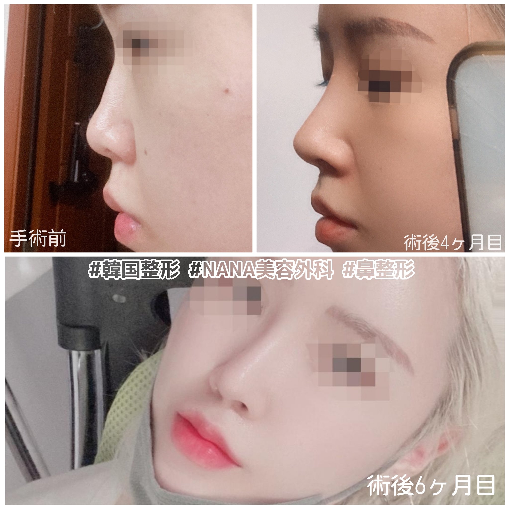 Twitter 上的 韓国nana美容外科 Nana鼻整形ビフォーアフター 低い鼻を綺麗に伸ばしたい 鼻柱を作りたい 横ラインを綺麗にしたい 只今韓国在住中の 留学生イベントも 行っております お問い合わせライン T Co Uktu5b4nbb Dmもok